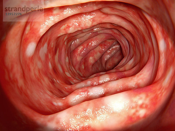 Colitis ulcerosa des Dickdarms  Illustration. Colitis ulcerosa ist eine entzündliche Erkrankung des menschlichen Darms.