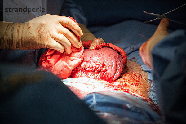 Reportage aus der Entbindungsstation des Krankenhauses Métropole Savoie in Chambéry  Frankreich. Eine geplante Entbindung per Kaiserschnitt. Nach der Entbindung wird die Gebärmutter aus dem Bauchraum entfernt  um genäht und inspiziert zu werden.