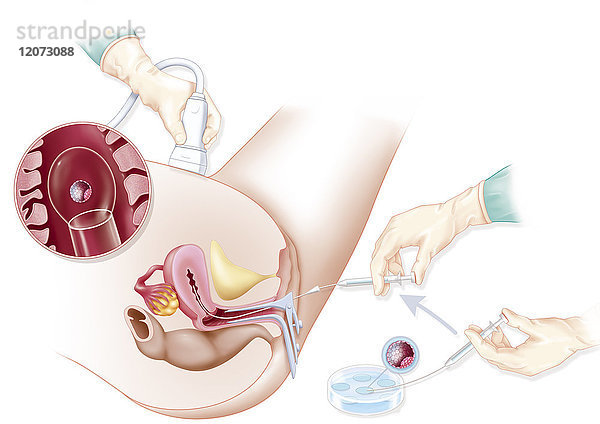 Illustration des Transfers von durch IVF gewonnenen Embryonen unter Ultraschallkontrolle. Die übertragenen Embryonen nisten sich in den Tagen nach dem Transfer in der Gebärmutter ein. Dies ist der letzte medizinische Akt bei der IVF-Behandlung.