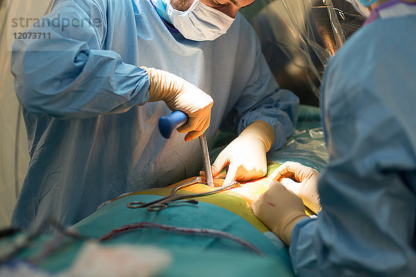 Reportage aus dem Operationssaal der orthopädischen Chirurgie im Krankenhaus Pasteur 2  Nizza  Frankreich. Markraumfreilegung und Arthrodese bei einem Patienten mit arthrosebedingter Lendenwirbelkanalstenose. Die Operation besteht darin  den Wirbelkanal von knöchernen Elementen zu befreien  die ihn zusammendrücken  und die Wirbelsäule mit einer Arthrodese zu verankern. Diese Operation wird mit dem O-Arm-System mit 3D-Bildern vor der Operation durchgeführt.