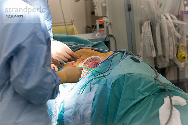 Reportage über eine Nierentransplantation in der urologischen Abteilung des Krankenhauses von Nizza  Frankreich. Die Niere wird von einem lebenden verwandten Spender  der Frau des Empfängers  entnommen. Das Ende der Operation zur Entfernung der Spenderniere. Der Wundspreizring ist noch vorhanden.