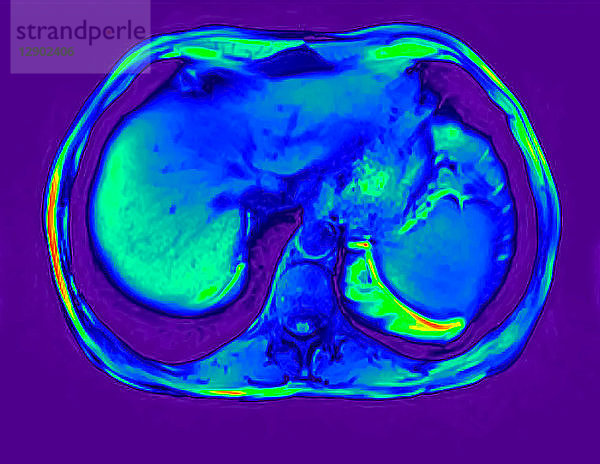 Querschnitt-Abdomen-MRT-Scan eines 60-jährigen männlichen Patienten mit Nierenstein