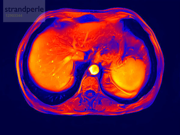 Querschnitt-Abdomen-MRT-Scan eines 60-jährigen männlichen Patienten mit Nierenstein