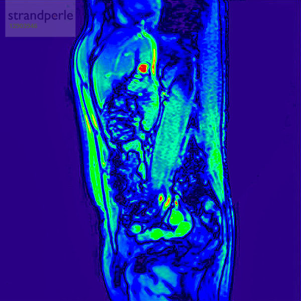 Seitenansicht Abdomen-MRT-Scan eines 60-jährigen männlichen Patienten mit Nierenstein