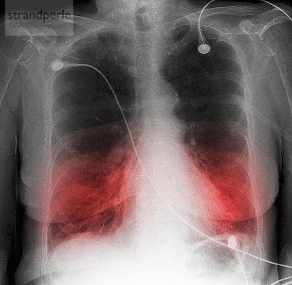 CXR eines älteren Rauchers mit COPD