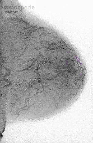 Röntgenbild der Brust mit Verkalkungen