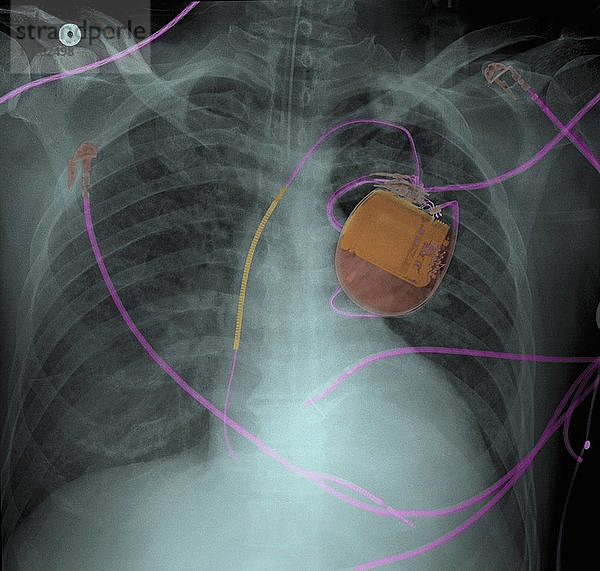 Thoraxröntgenbild von Herzschrittmacher und Lungenödem