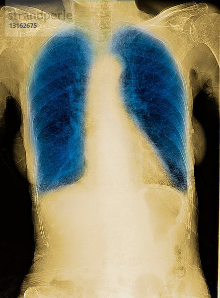 CXR einer älteren Raucherin mit COPD