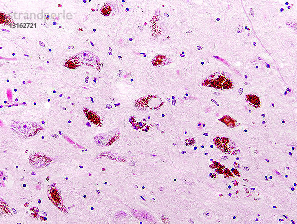 Parkinson-Krankheit  Substantia nigra  Lewy-Körperchen