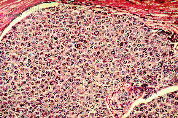 lichtmikroskopische Histologie von Brustkrebszellen