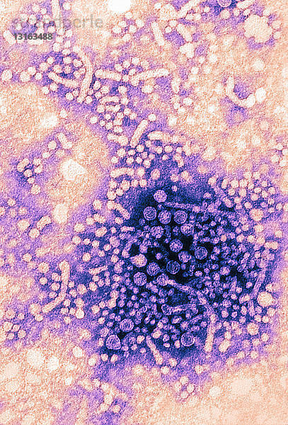 TEM mit Partikeln des Hepatitis-B-Virus