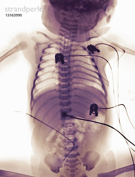 Röntgenbild eines neugeborenen Mädchens