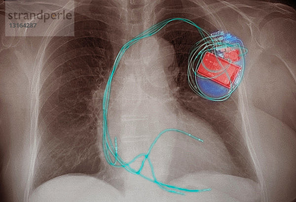 Brust-Röntgenbild zeigt einen implantierten PaCemaker