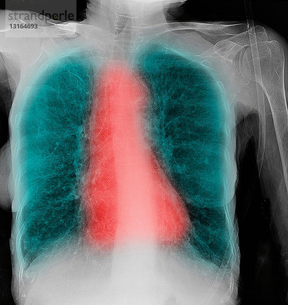 CXR einer älteren Raucherin mit COPD