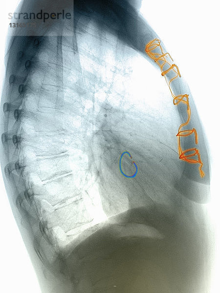 Brust-Röntgenbild vom Ersatz einer Herzklappe