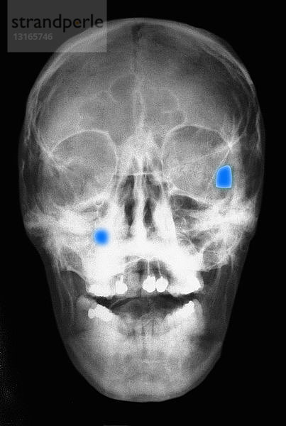 Röntgenaufnahme des Schädels mit zwei Kugeln
