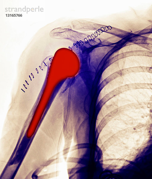 Röntgenbild  Schulterersatz bei einer 78-jährigen Frau