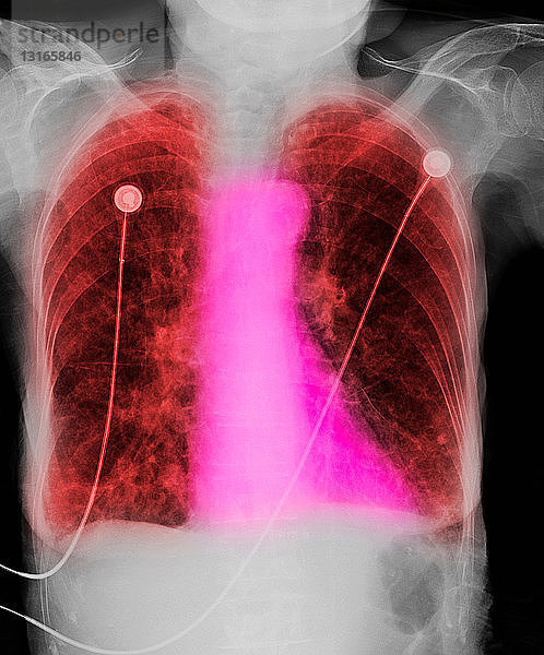 CXR einer älteren Raucherin mit COPD