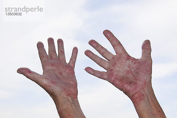 Patient mit atopischer Dermatitis oder endogenem Ekzem  Deutschland  Europa