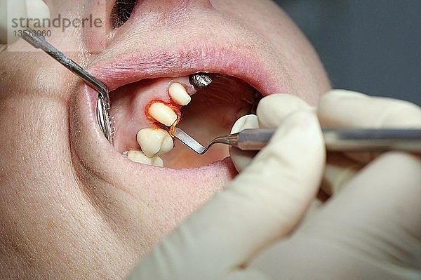 Retraktionsfaden  der während einer Zahnbehandlung um den Zahnstumpf gewickelt wird