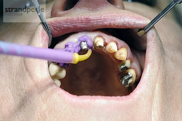 Masse  die für den Korrekturabdruck während der Zahnbehandlung verwendet wird