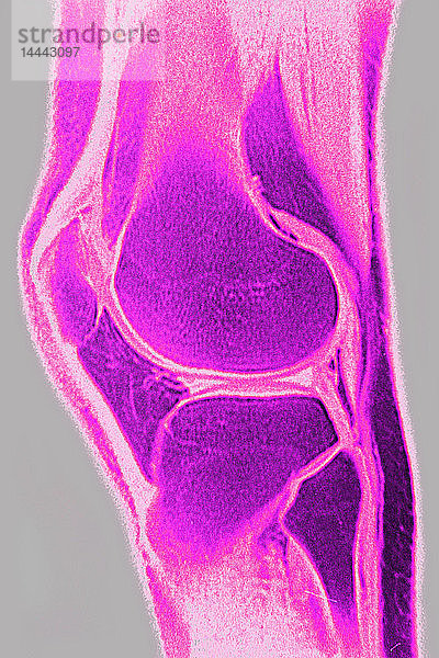 Normales Knie auf einem MRT-Scan im Sagittalschnitt.