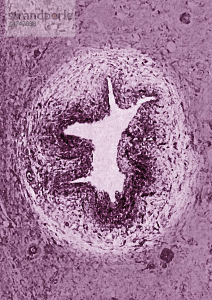 ARTERIOSKLEROSE  HISTOLOGIE