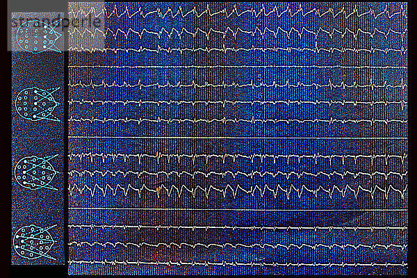 Schlafapnoe  die auf einem EEG (Elektroenzephalogramm) zu sehen ist.