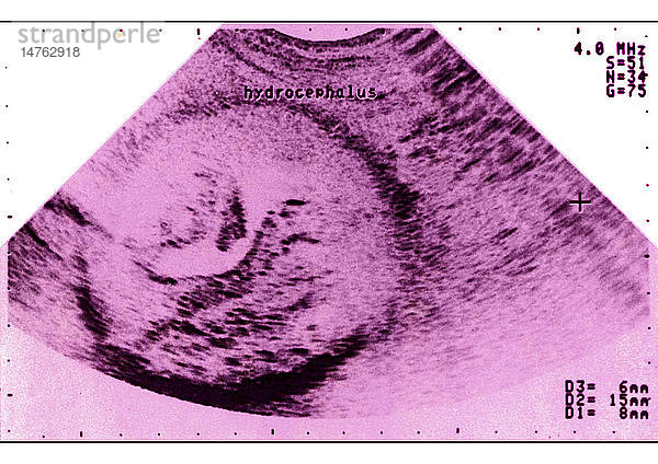 SONOGRAPHIE DES HYDROZEPHALUS