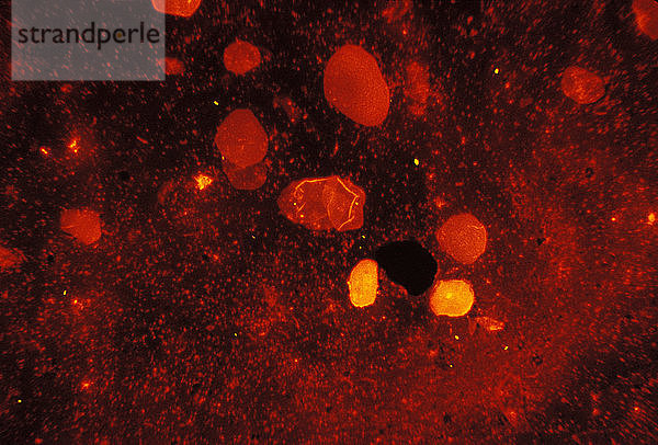 Hier sehen wir Mycobacterium tuberculosis in einem Sputumabstrich  der mit einer fluoreszierenden säurefesten Färbung angefärbt wurde. M. tuberculosis ist ein säurefestes Bakterium (AFB) und kann daher mit der Gram-Färbetechnik nicht nachgewiesen werden. Mit dieser Methode leuchten die M. tuberculosis-Bakterien jedoch unter dem UV-Lichtmikroskop gelb.