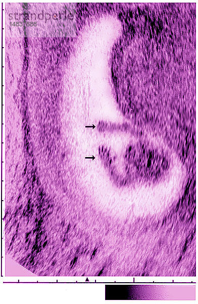 ULTRASCHALLBIOMETRIE DES FÖTUS