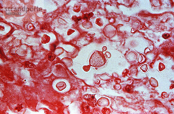 Diese Mikrofotografie zeigt die Anzahl der Cryptococcus neoformans-Pilze  die für die Kryptokokkose verantwortlich sind. Dieses Präparat wurde von einer Lungenprobe erstellt und mit der Hämotoxylin- und Eosin-Färbetechnik (H&E) gefärbt. Die Kryptokokkose  die zunächst eine Lungeninfektion ist  kann sich zu einer systemisch verbreiteten Krankheit entwickeln  die zu einer Meningoenzephalitis  einer Entzündung des Gehirns und seiner Umhüllung  führt. Personen mit HIV oder immungeschwächte Personen  die sich einer Chemotherapie unterziehen  sind besonders anfällig.