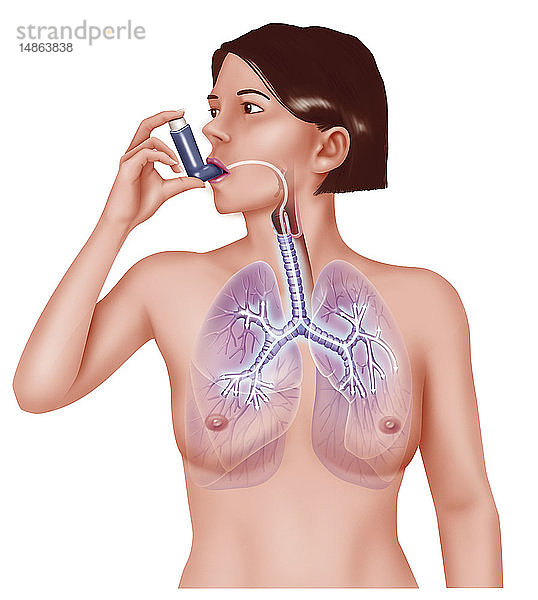 ASTHMA-BEHANDLUNG  ILLUSTRATION