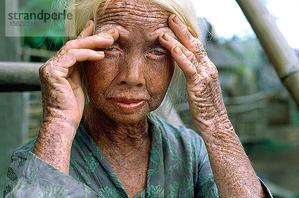 Porträt einer älteren Albino-Frau  die ihr Gesicht in einem abgelegenen Dorf berührt  Dorf Sumbawa  Sumbawa  Indonesien