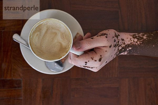 Nahaufnahme von oben der Hand eines Mannes mit Vitiligo  der eine Kaffeetasse hält