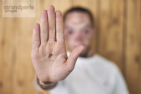 Nahaufnahme der Hand eines Mannes mit Vitiligo