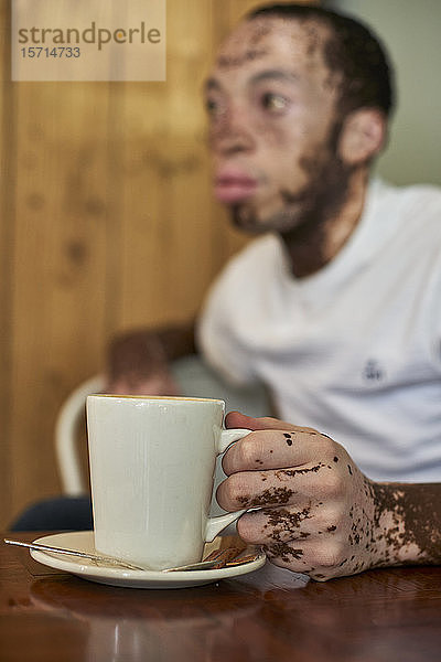 Junger Mann mit Vitiligo sitzt in einer Cafeteria und hält einen Kaffeebecher