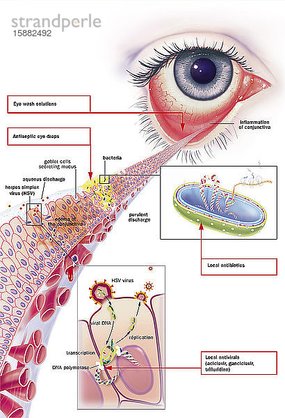 Infektiöse Bindehautentzündung und ihre Behandlung. Ansicht eines Auges mit Entzündung der Bindehaut. Zoom auf die Bindehaut mit von oben nach unten 1 bakteriellen Infektion (grün) und 1 viralen Infektion (rot-orange). Bei gelbem  eitrigem Ausfluss  der durch Bakterien (grün) verursacht wird  sind die Zellen der Bindehaut zerstört. Becherzellen  die Schleim absondern  und Ödeme der Bindehaut in dem mit dem Virus infizierten Bereich. Rechts von oben nach unten: ein Bakterium im Schnitt  ein Fenster mit einer infizierten Bindegewebszelle (Herpes-Simplex-Virus)  das den Prozess der viralen Replikation im Detail zeigt: Transkription der viralen DNA  DNA-Polymerase  virale Replikation