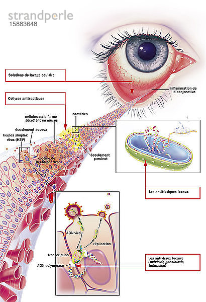 Infektiöse Bindehautentzündung und ihre Behandlung. Ansicht eines Auges mit Entzündung der Bindehaut. Zoom auf die Bindehaut mit oben und unten 1 bakterielle Infektion (grün) und 1 virale Infektion (rot-orange). Bei gelbem  eitrigem Ausfluss aufgrund der Anwesenheit von Bakterien (grün) sind die Zellen der Bindehaut zerstört. Becherzellen  die Schleim absondern  und Ödeme der Bindehaut in der vom Virus infizierten Zone. Rechts von oben nach unten: ein Bakterium im Schnitt  ein Fenster mit einer infizierten Bindehautzelle (Herpes-Simplex-Virus)  das den Prozess der viralen Replikation zeigt: Transkription der viralen DNA  DNA-Polymerase  virale Replikation