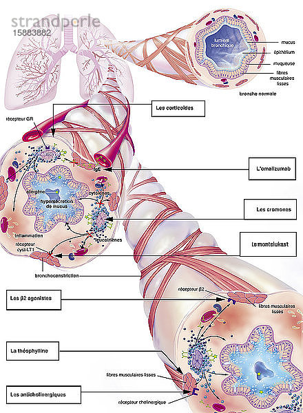 Asthma  normale Bronchiole  asthmatische Bronchiole mit Bronchokonstriktion  Hypersekretion  Behandlungen. Darstellung der Lunge mit dem Bronchialbaum  von dem 3 Zooms ausgehen. Oben links: eine gesunde Bronchiole  unten: zwei asthmatische Bronchiolen. Ein Allergen (grüner Stern) löst den Asthmaanfall aus  indem es Lymphozyten aktiviert  die IgE (grünes Y) produzieren  was die Degranulation von Mastzellen (violett) verursacht  die Leukotriene (schwarze Kügelchen) und Zytokine (blaue Kügelchen) freisetzen und eine Entzündung der Schleimhaut vermitteln  die zu einer Bronchokonstriktion der glatten Muskelfasern  einer Hypersekretion von Schleim und einer Obstruktion der Atemwege führt.