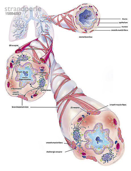 Asthma und seine Behandlung. Darstellung der Lunge mit dem Bronchialbaum  von dem 3 Zooms ausgehen. Oben links  eine gesunde Bronchiole  unten zwei asthmatische Bronchiolen. Ein Allergen (grüner Stern) löst den Asthmaanfall aus  indem es Lymphozyten aktiviert  die IgE (grünes Y) produzieren  was zur Degranulation von Mastzellen (violett) führt  die Leukotriene (schwarze Kügelchen) und Zytokine (blaue Kügelchen) freisetzen und eine Entzündung der Schleimhaut vermitteln  die zu einer Bronchokonstriktion der glatten Muskelfasern  einer Hypersekretion von Schleim und einer Obstruktion der Atemwege führt.