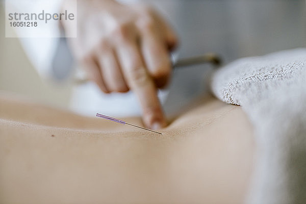 Akupunktur  Rücken mit Akupunkturnadel während der Behandlung