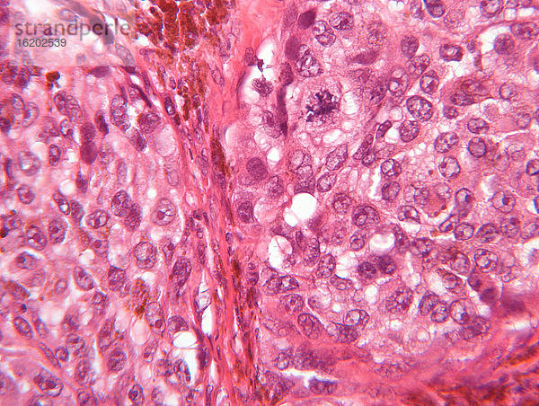 Mikroskopische Ansicht eines malignen Melanoms