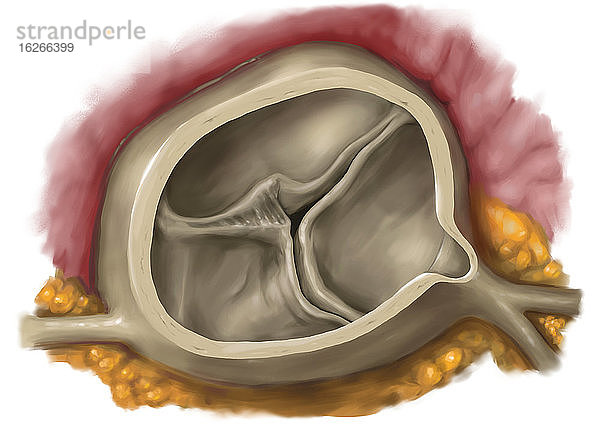 Fötale Aortenstenose  Illustration