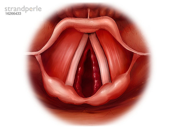 Laryngitis subglottica  Illustration