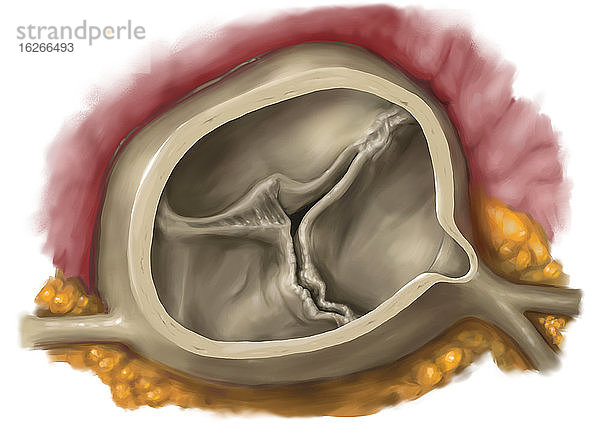 Aortenklappenstenose  Illustration