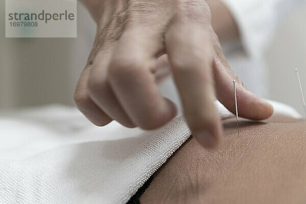Ein Arzt  der Akupunktur durchführt  sticht eine Nadel in den Magen eines Patienten.