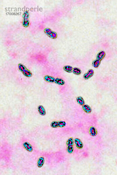 Pneumokokken-Bakterien (Streptococcus pneumoniae). Pneumokokken sind ein wichtiger Krankheitserreger beim Menschen. Er ist für viele Infektionen (Lungenentzündung) verantwortlich. Er war für die Lungenentzündung während der Spanischen Grippe verantwortlich). Durch Lichtmikroskopie sichtbar gemacht. .