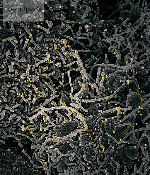 Kolorierte rasterelektronenmikroskopische Aufnahme einer VERO E6-Zelle (grau) mit verlängerten Zellfortsätzen und Anzeichen von Apoptose nach Infektion mit SARS-COV-2-Viruspartikeln (gelb)  die aus einer Patientenprobe isoliert wurden. Das Bild wurde in der NIAID Integrated Research Facility (IRF) in Fort Detrick  Maryland  aufgenommen. Bildnachweis: NIAID.