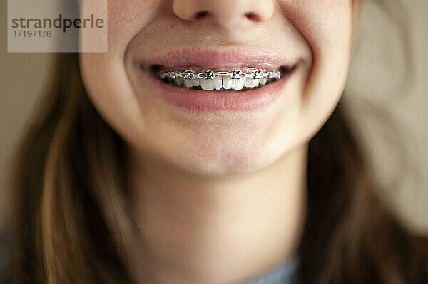 Nahaufnahme einer Zahnspange auf den Zähnen eines jungen Mädchens vor einer leeren Wand